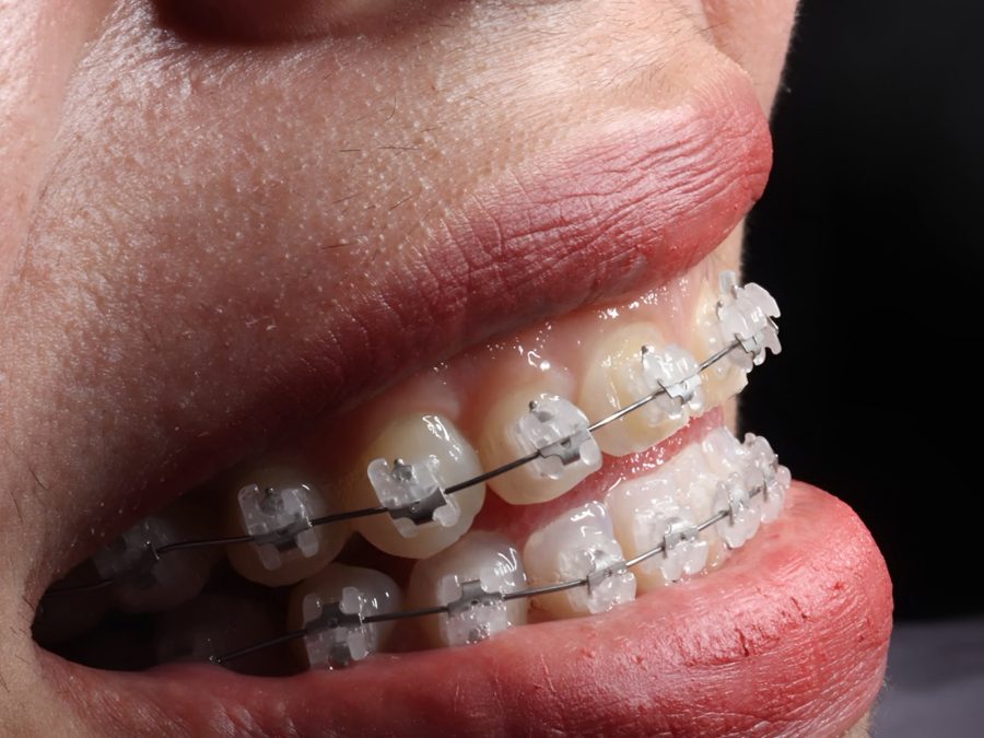 Brackets autoligados estéticos, vista lateral