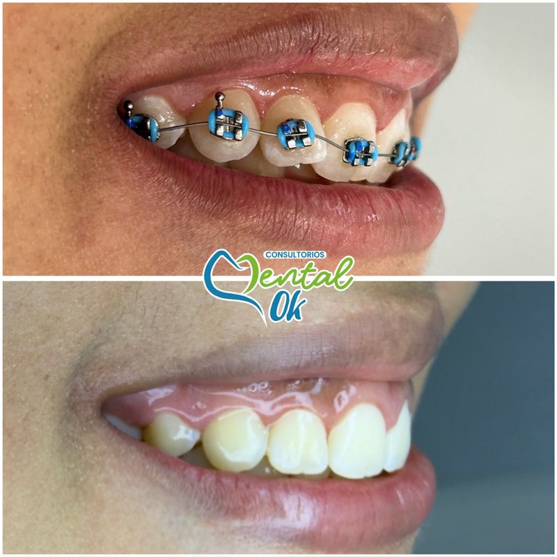 Sonrisa lateral con brackets y al terminar el tratamiento