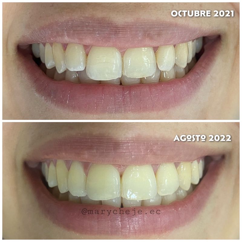 Sonrisa antes y después: octubre de 2021 y agosto de 2022