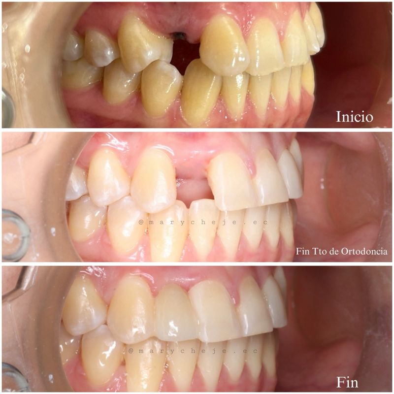 Vista lateral: inicio, fin de la ortodoncia y resultado final