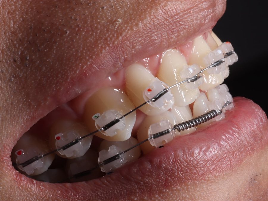 Brackets cerámicos, vista lateral