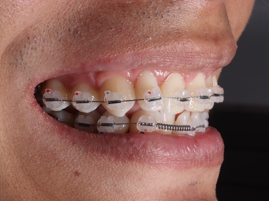 Brackets cerámicos en arcada superior e inferior