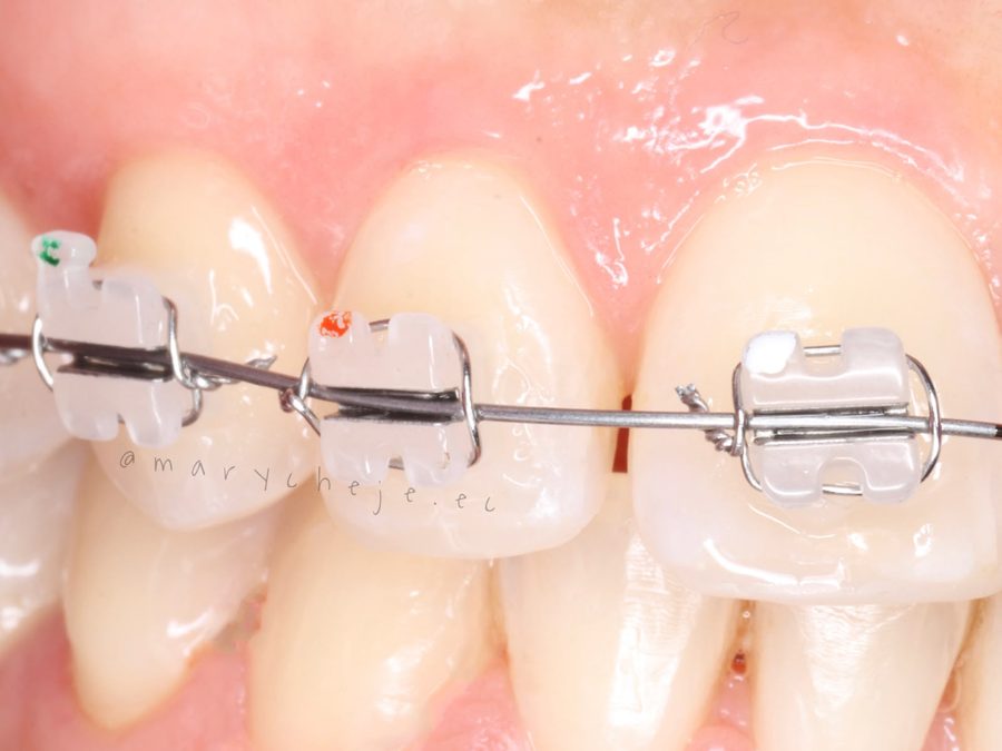 Brackets cerámicos en dientes superiores, de cerca