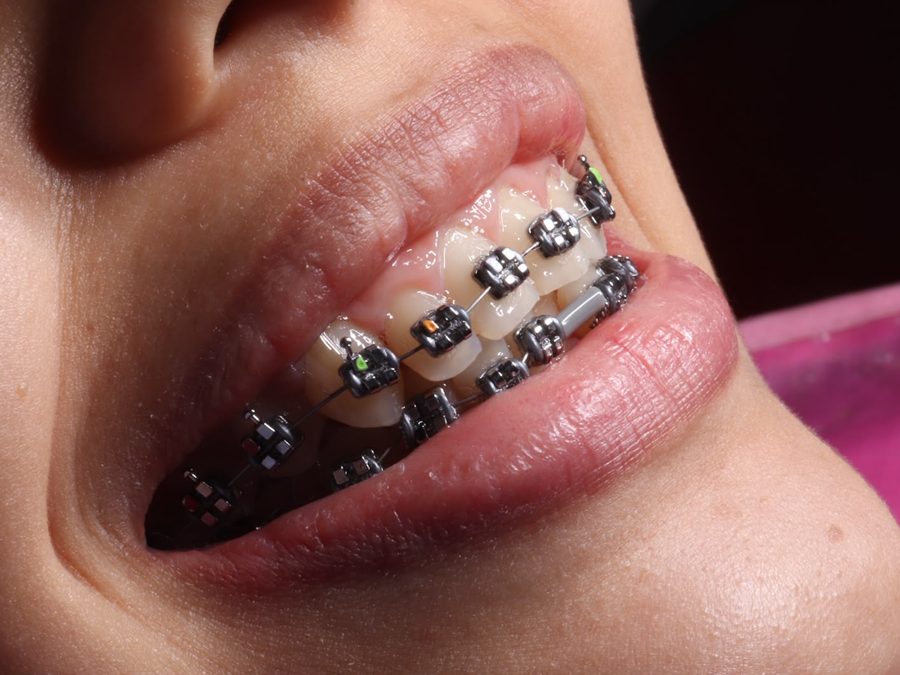 Brackets metálicos convencionales, vista lateral