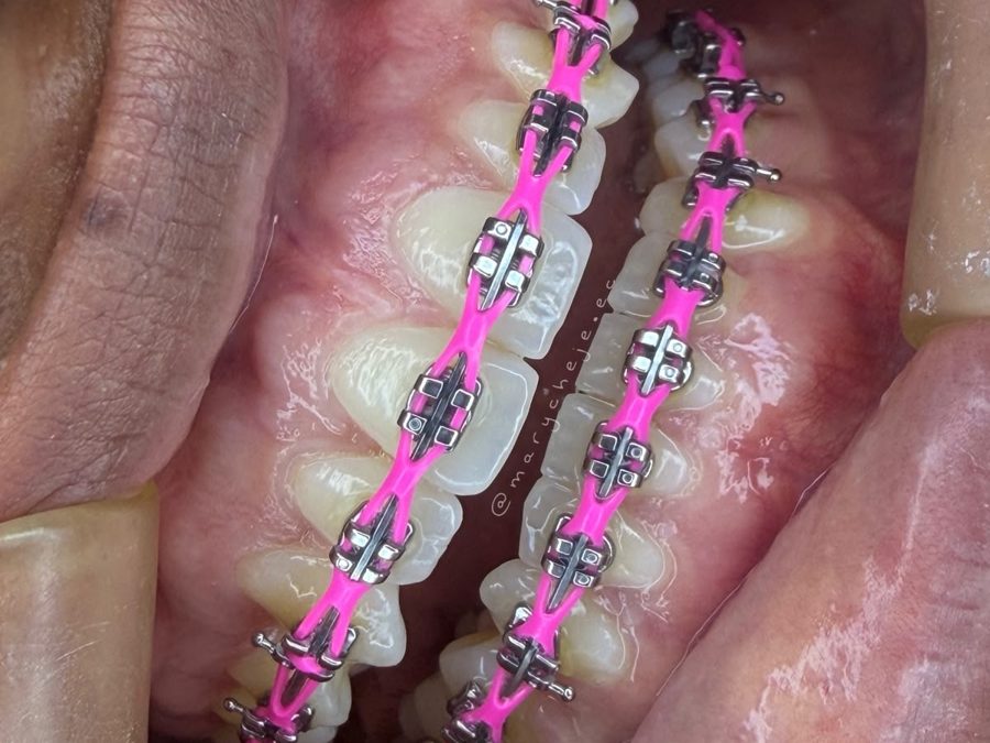 Brackets metálicos con cadena rosada