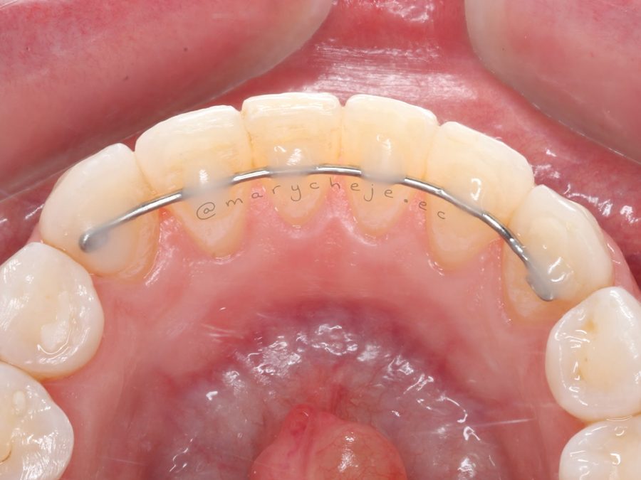 Retenedor fijo adherido por detrás de los dientes anteriores inferiores