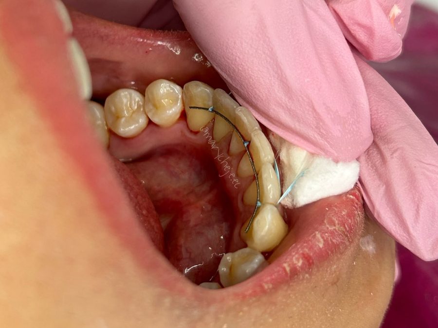 Retenedor fijo en la cara interna de los dientes inferiores